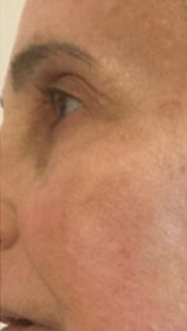 After Woman 's Face With Wrinkles — Saint Johns, FL — Live Without Lines Med Spa
