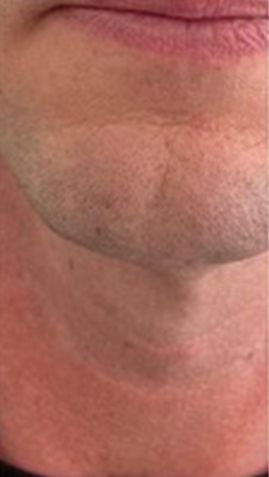 After Man 's Neck With Wrinkles — Saint Johns, FL — Live Without Lines Med Spa