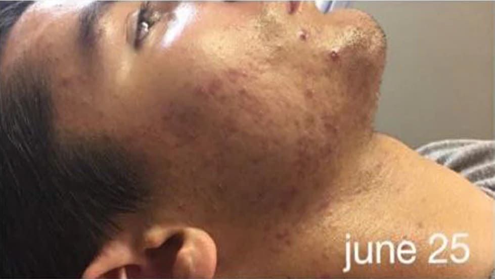 After Acne Treatment — Saint Johns, FL — Live Without Lines Med Spa