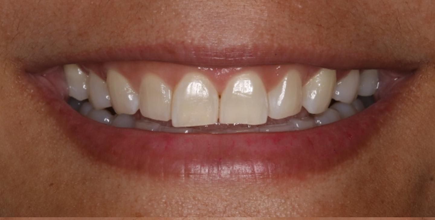 A close up of a woman 's smile with white teeth.