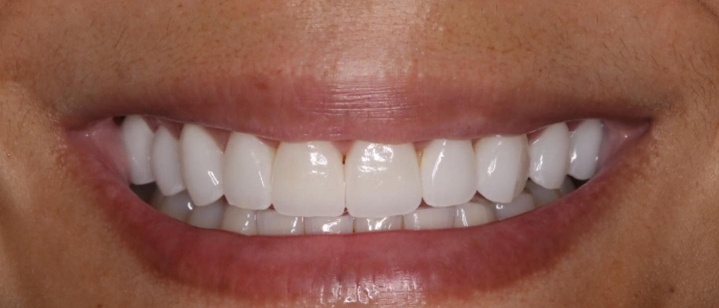 A close up of a woman 's smile with white teeth.