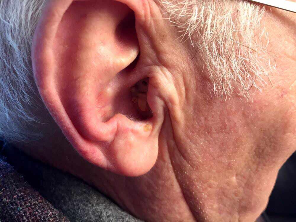 Hearing Aid — Completely-In-Canal Hearing Aid — Bend, OR
