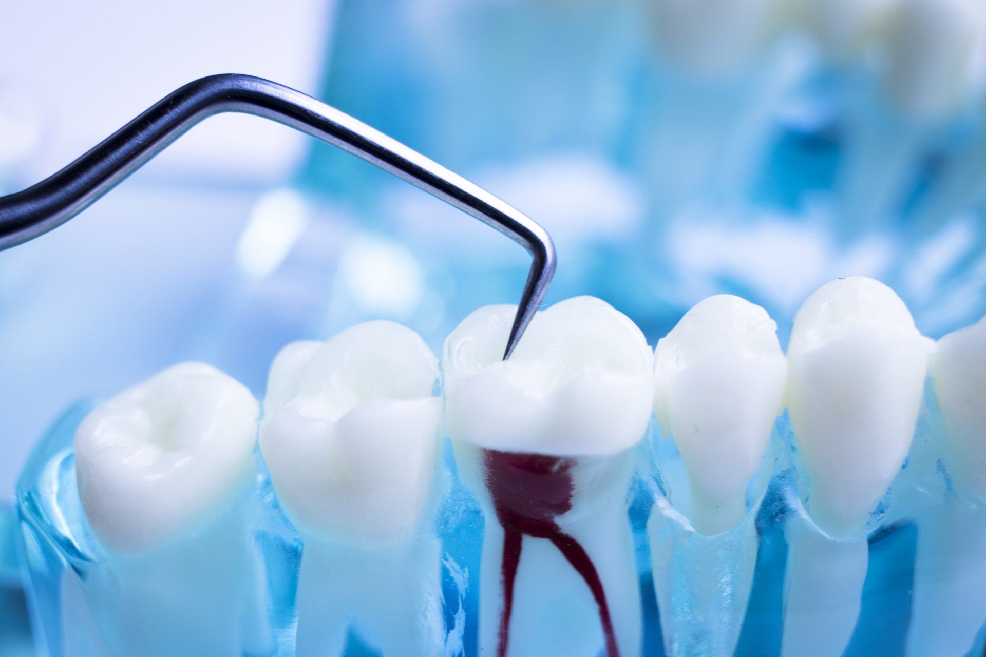 Root Canal Therapy in Statesville, NC