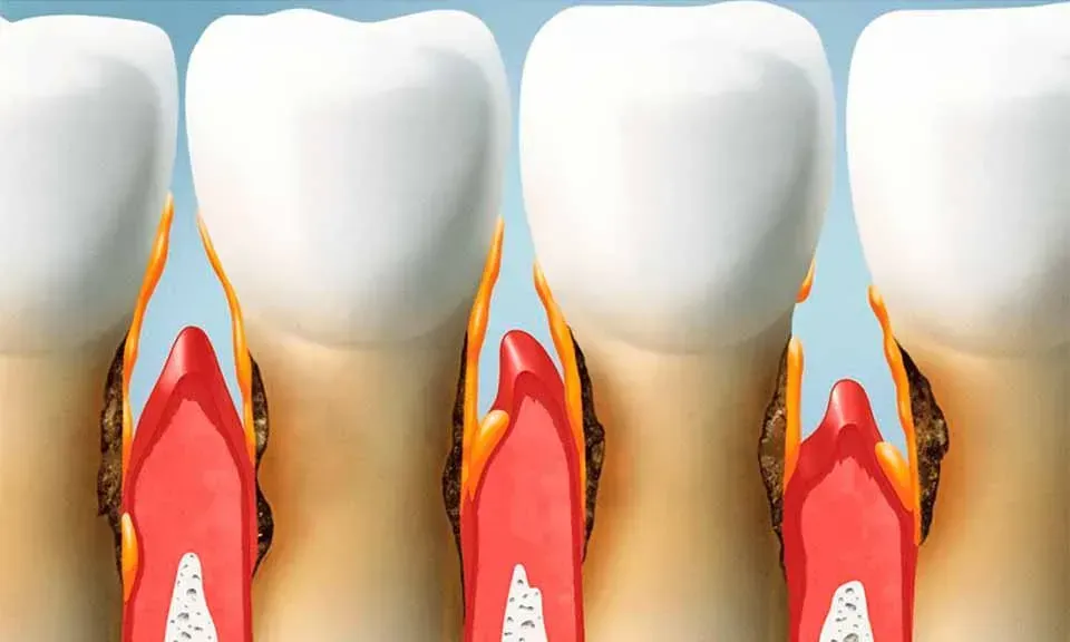 CLÍNICA DE PERIODONCIA 