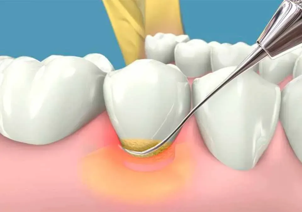 CLÍNICA DE PERIODONCIA 