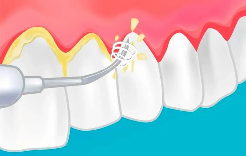CLÍNICA DE PERIODONCIA 