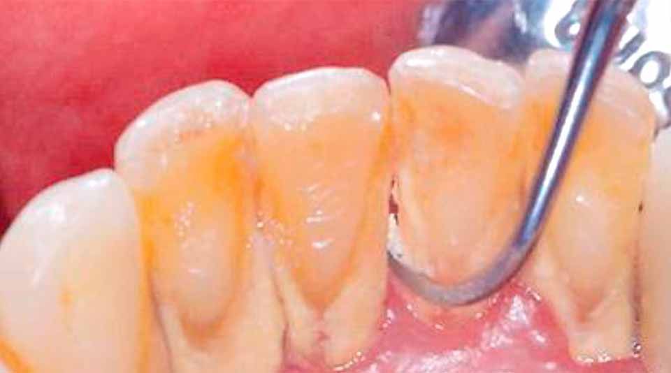 CLÍNICA DE PERIODONCIA 