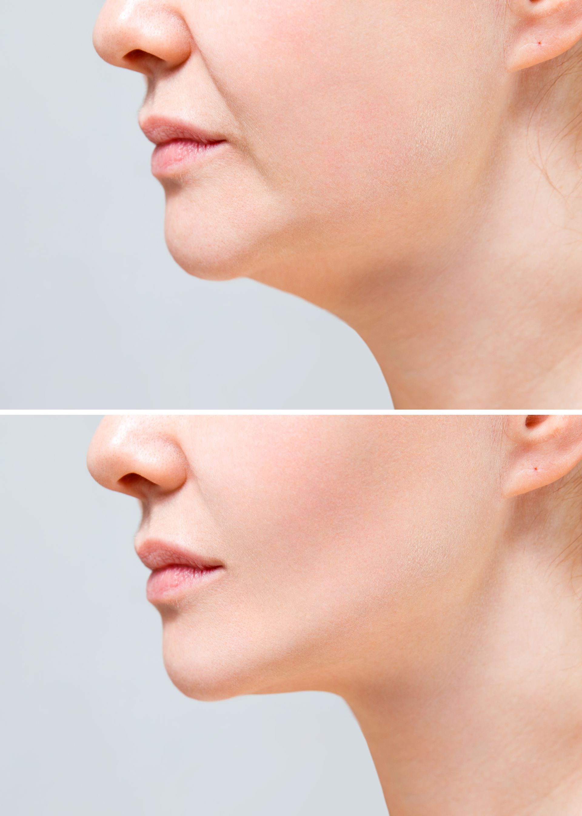 A before and after photo of a woman 's neck and chin.