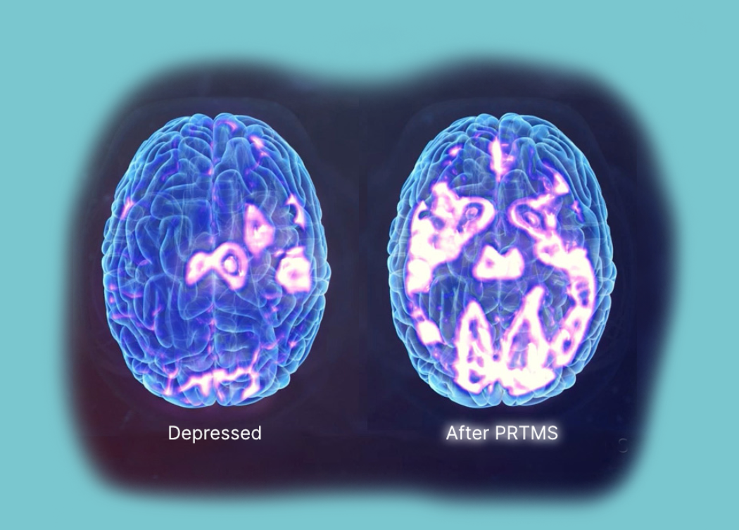 Two brain scans: Depressed (left) shows less activity than the one after rTMS (right), both in shades of blue and purple.