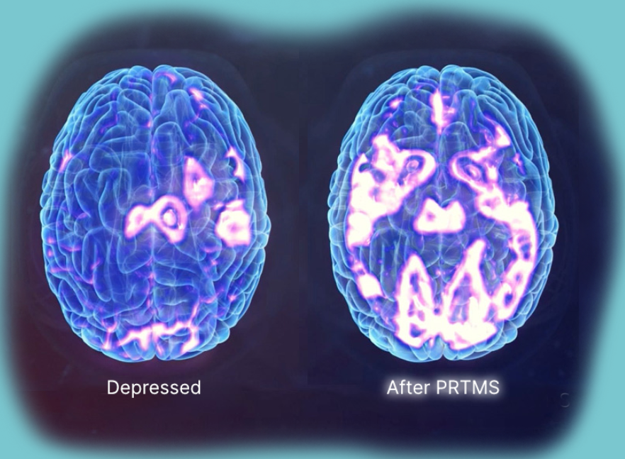 Brain scans showing brain activity in a depressed patient before and after PRTMS treatment.