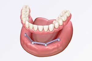 A computer generated image of a denture with a metal bar attached to it.