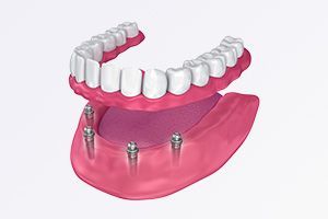 An illustration of a full denture with screws in it.