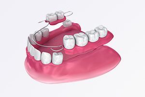 A 3d rendering of a denture with a partial denture attached to it.