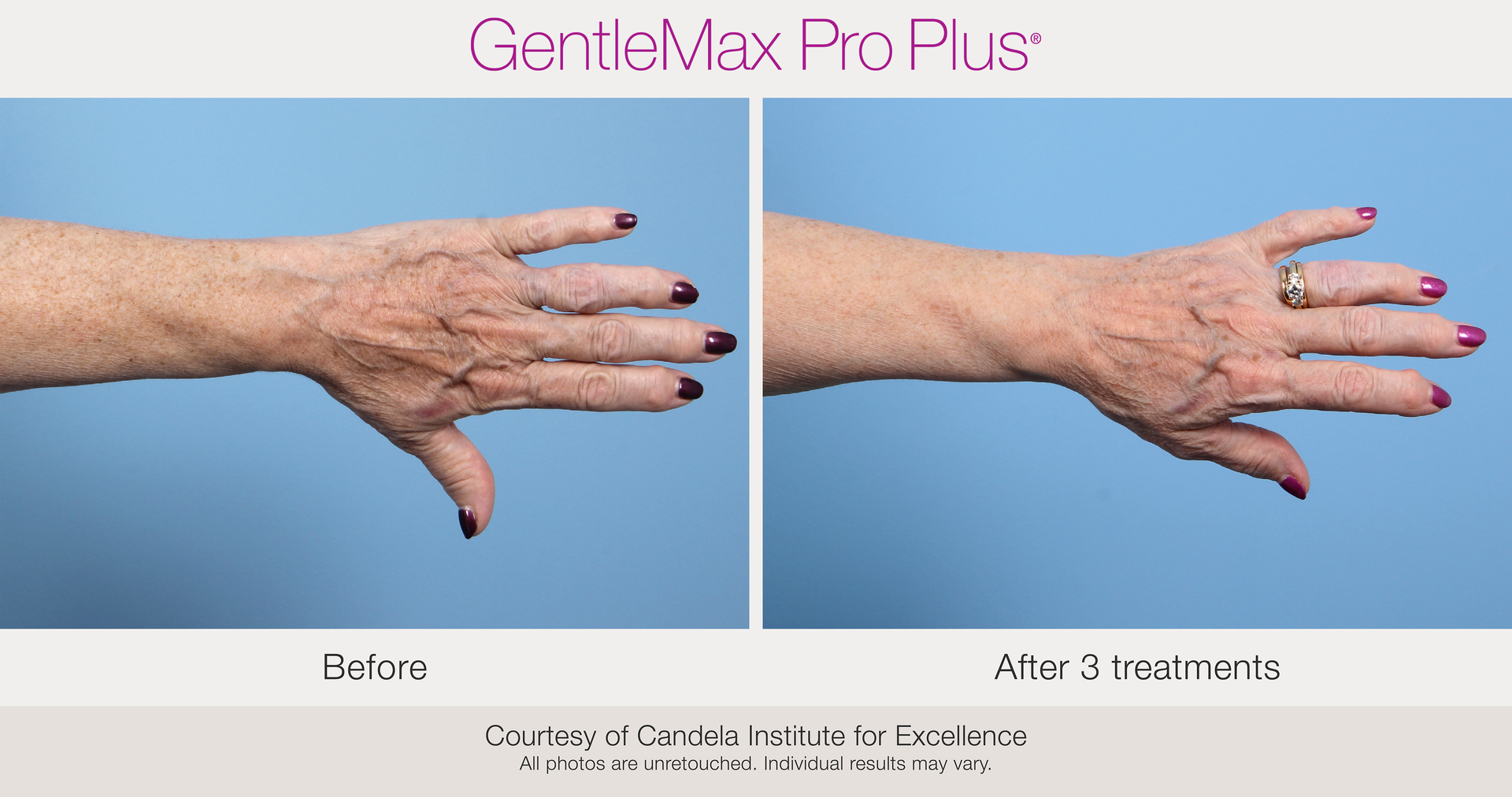 Benign Pigmentation Removal