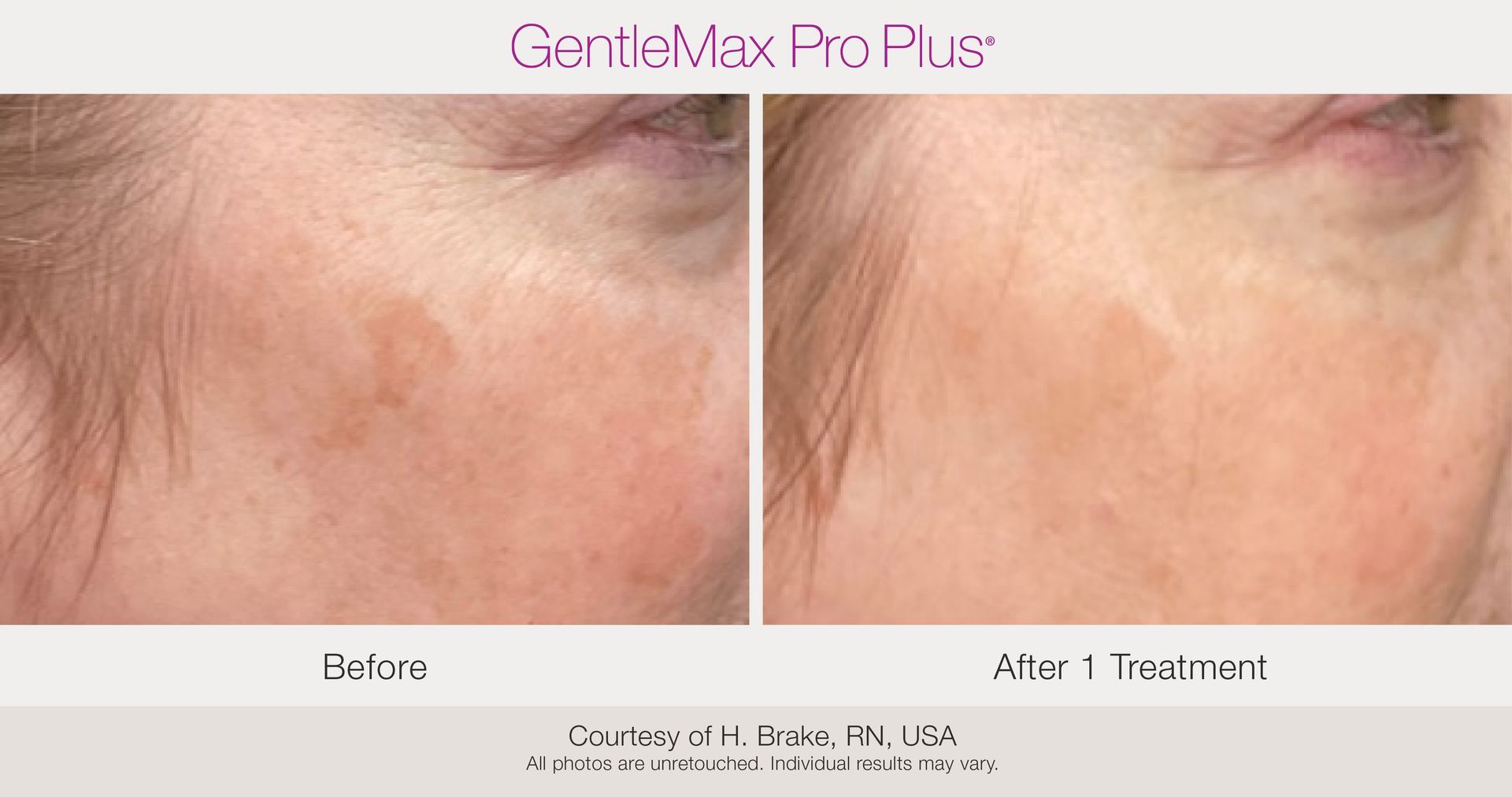 Benign Pigmentation Removal