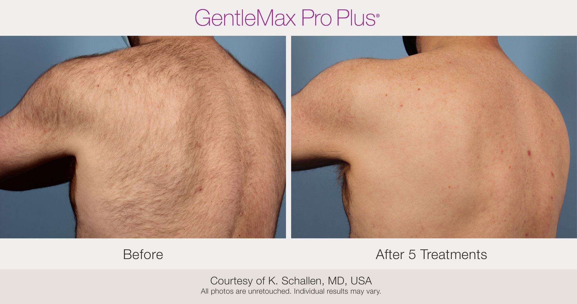 Before and After Laser Hair Removal