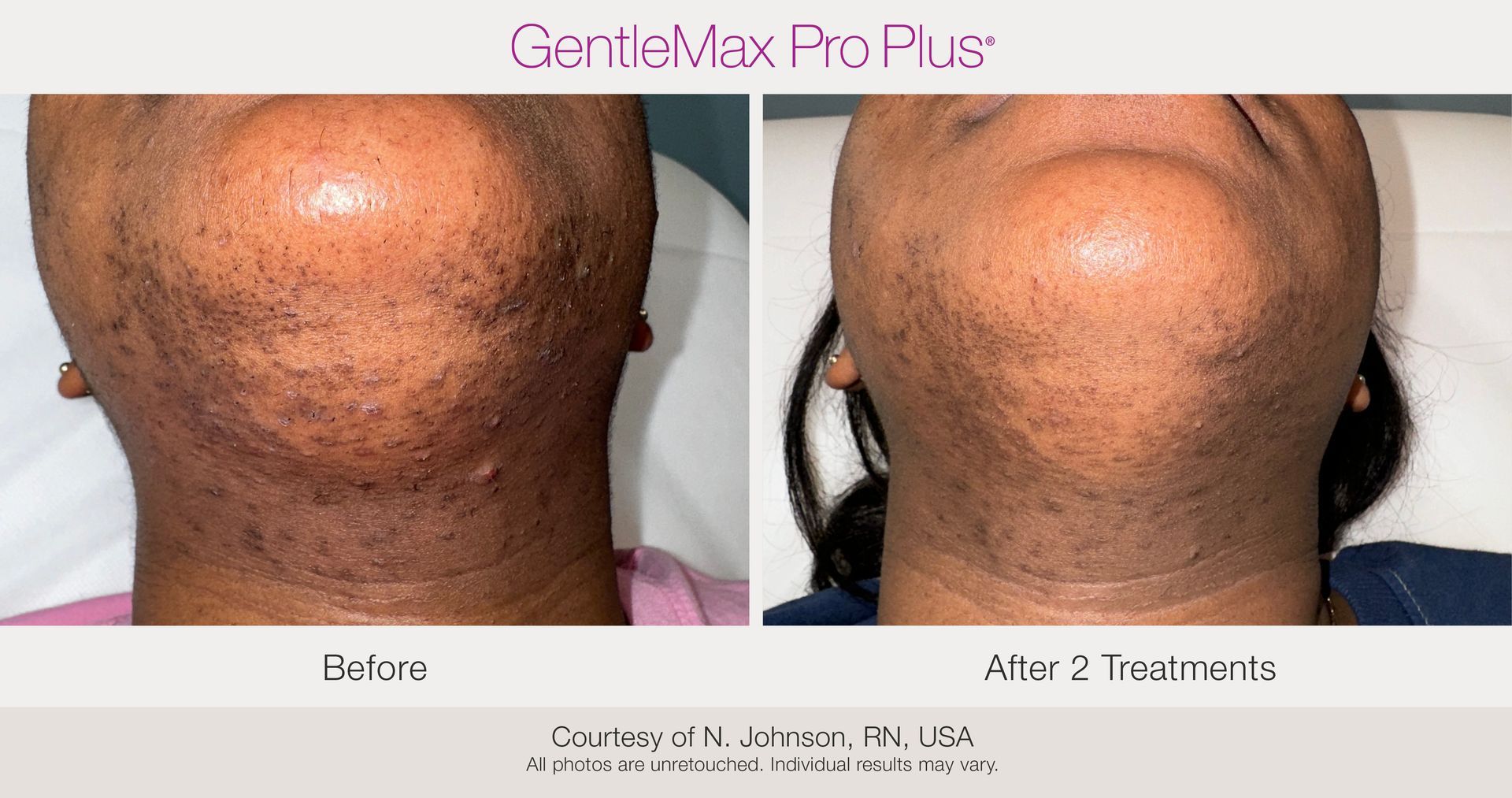 Before and After Laser Hair Removal