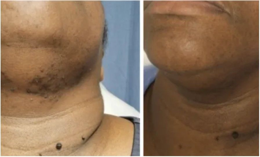 Before and After Laser Hair Removal