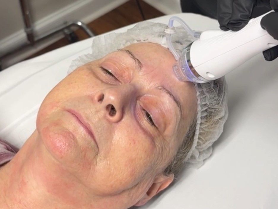 RF Microneedling