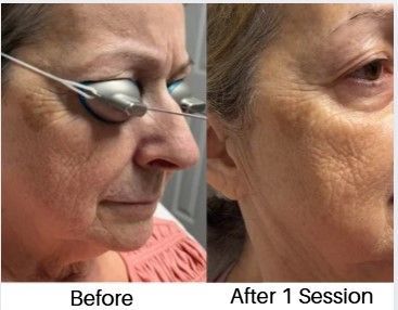Benign Pigmentation Removal