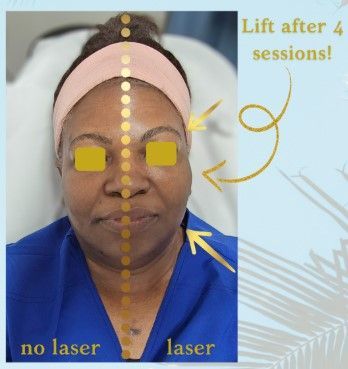 Laser Facial
