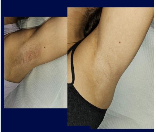 Before and After Laser Hair Removal