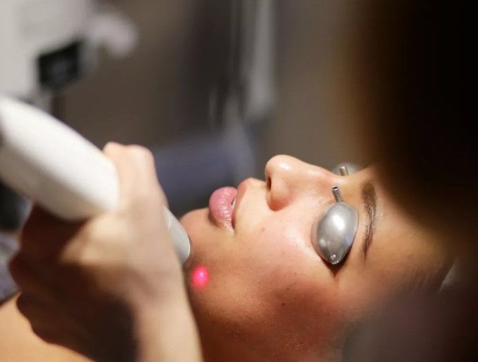 Chemical Peels