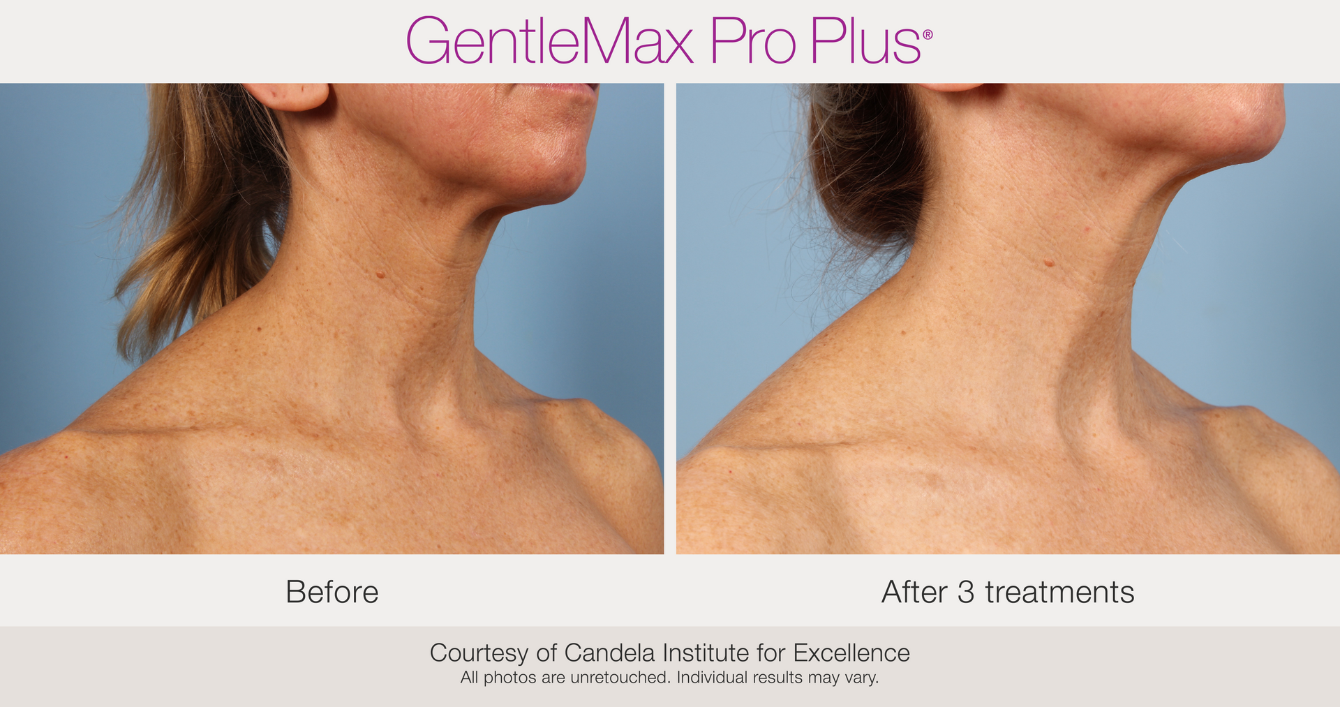 Benign Pigmentation Removal