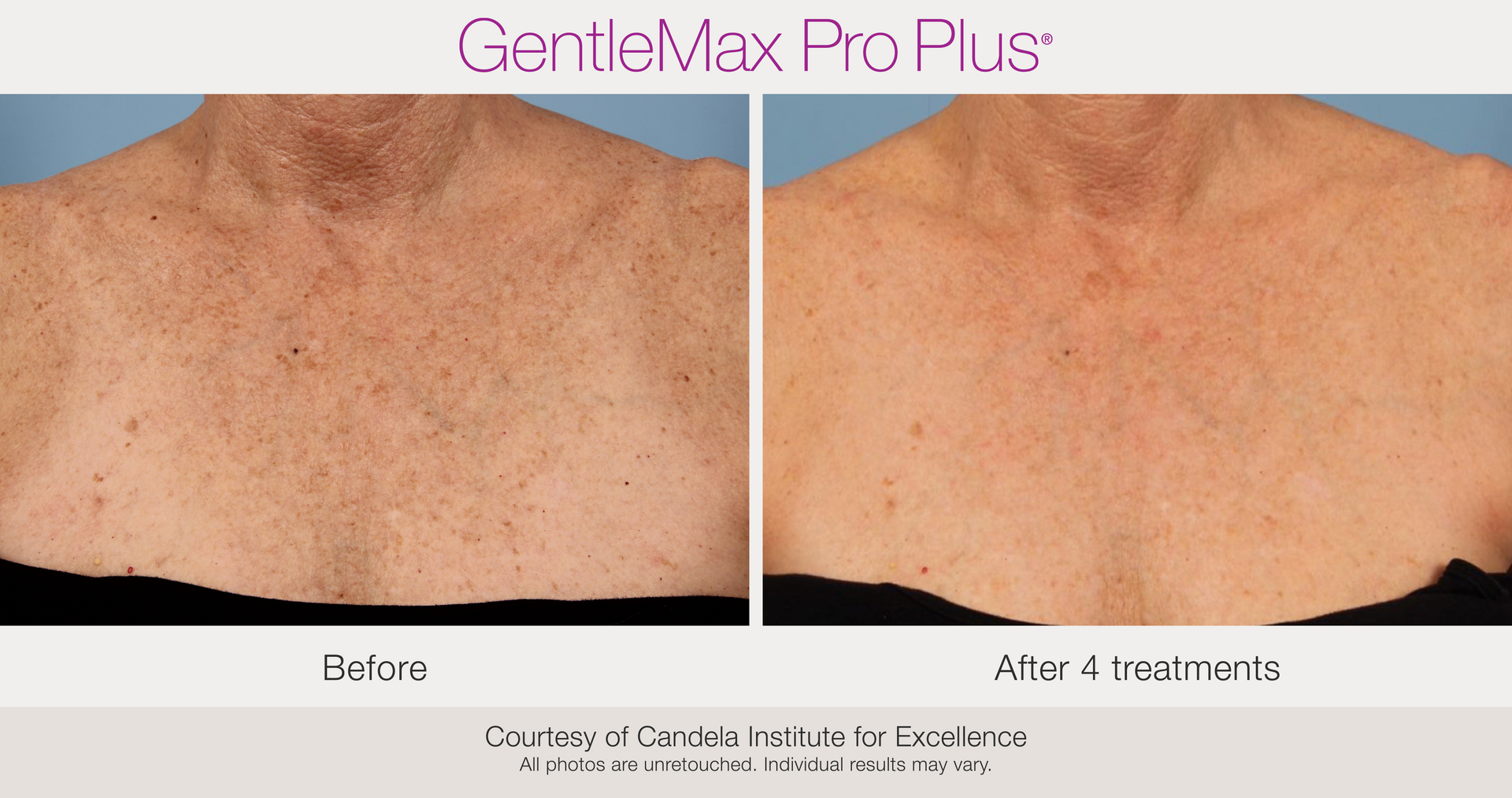 Benign Pigmentation Removal