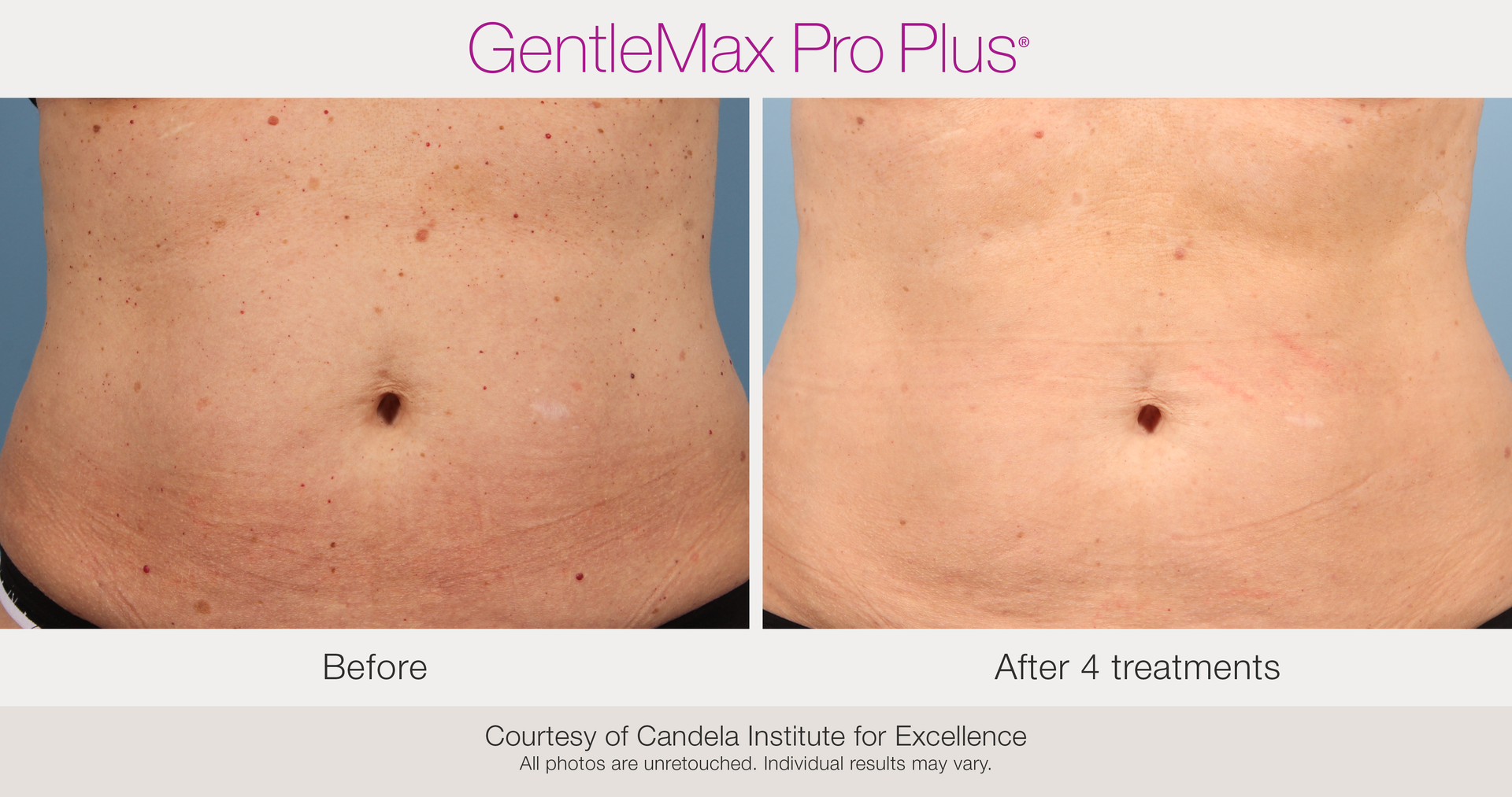 Benign Pigmentation Removal