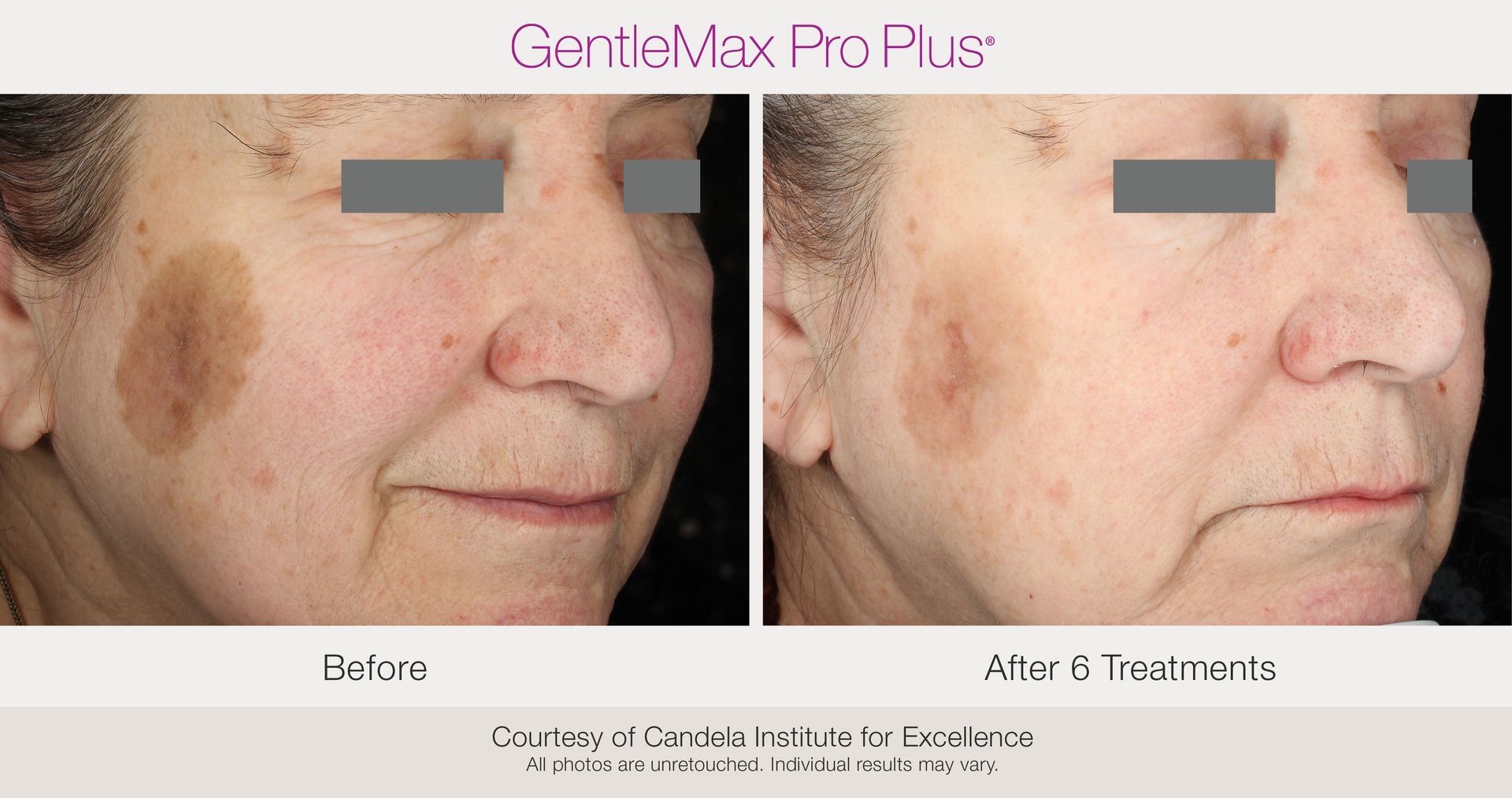 Benign Pigmentation Removal