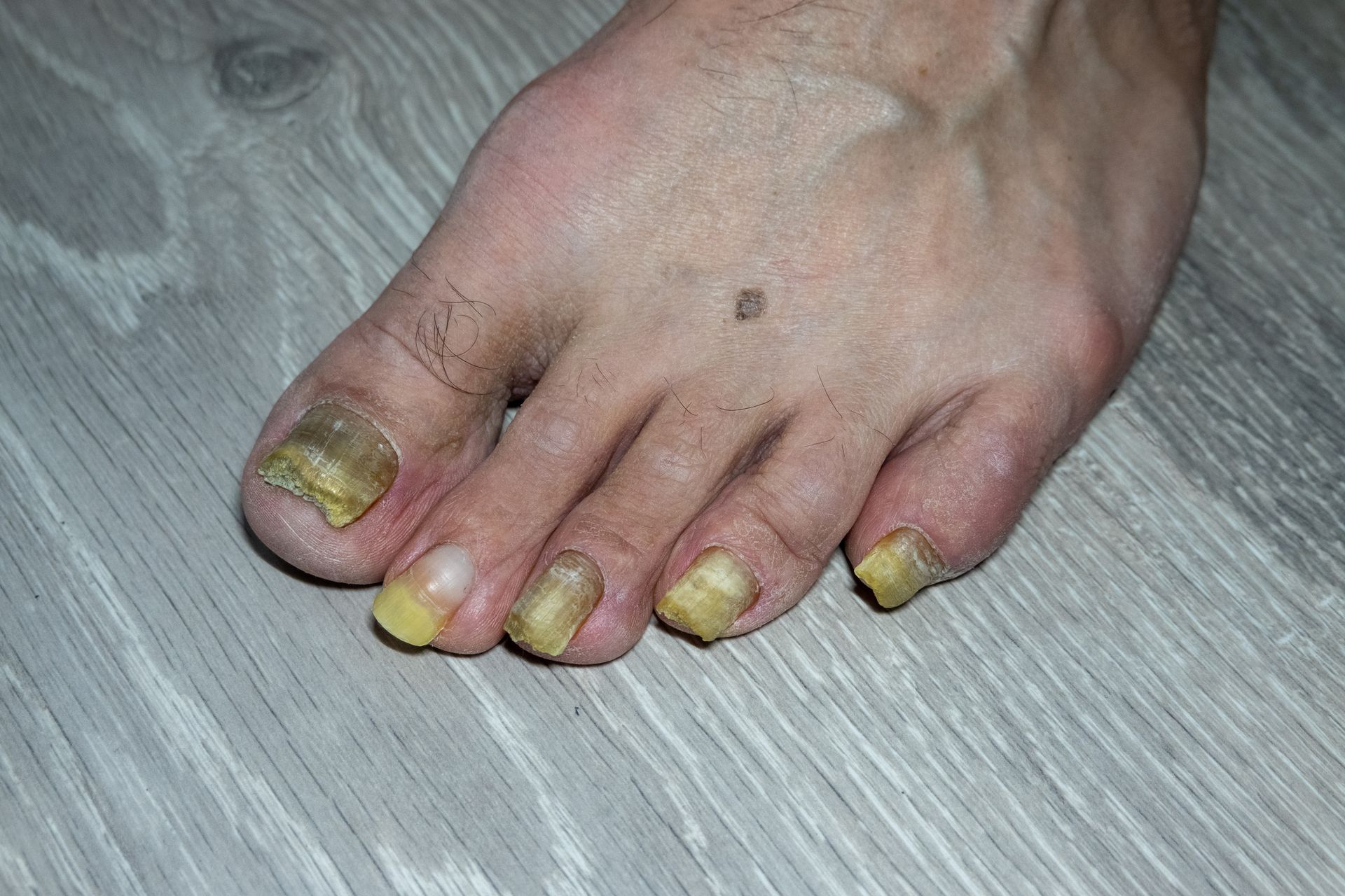 Nail Discoloration Treatment