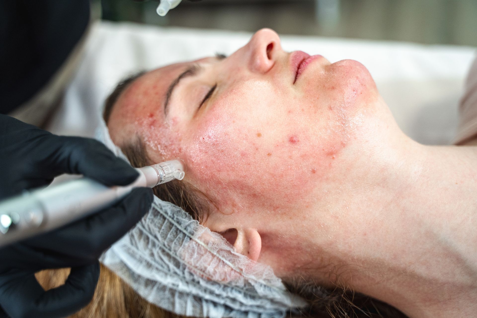 Microneedling