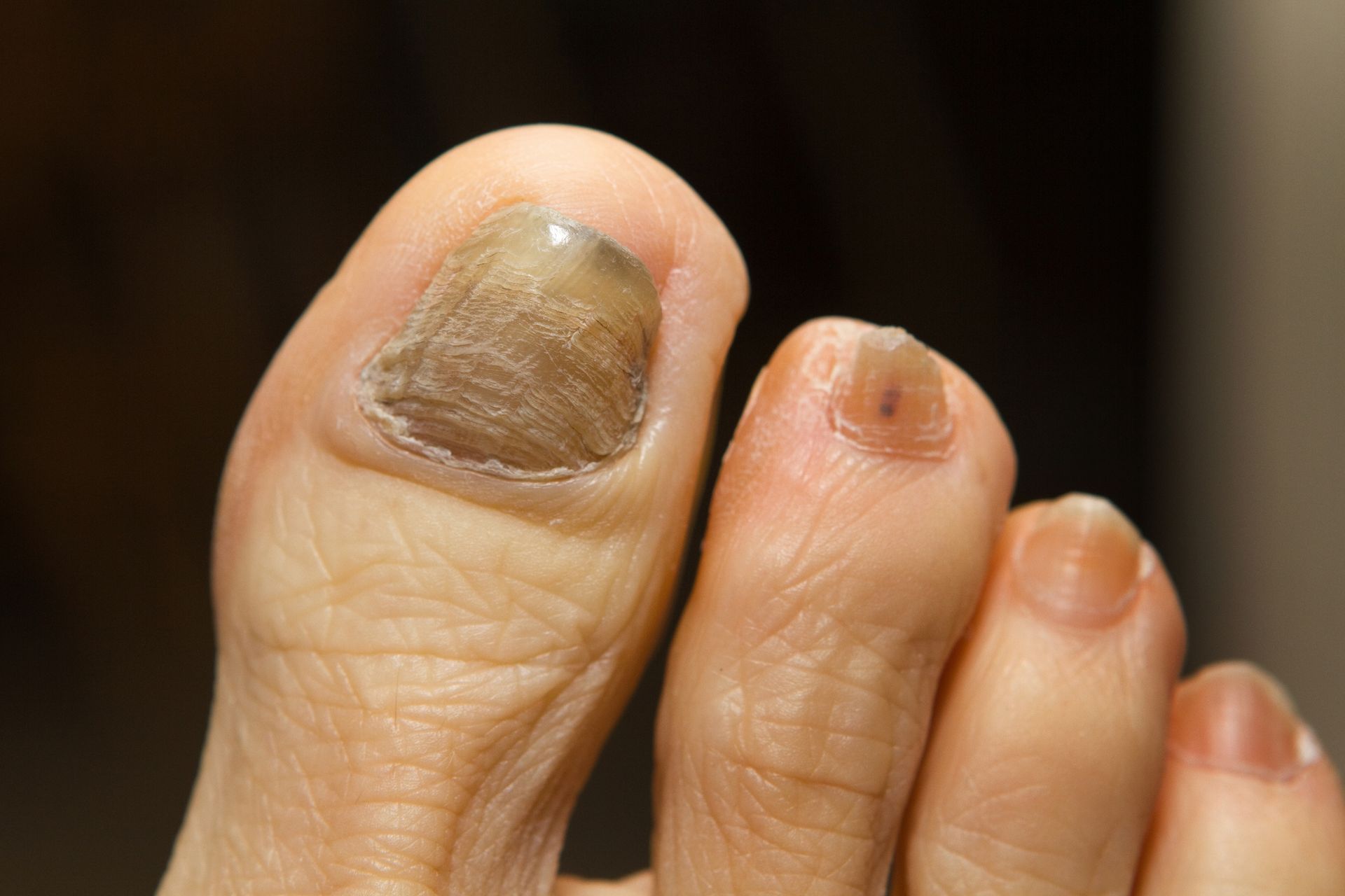 Nail Discoloration Treatment