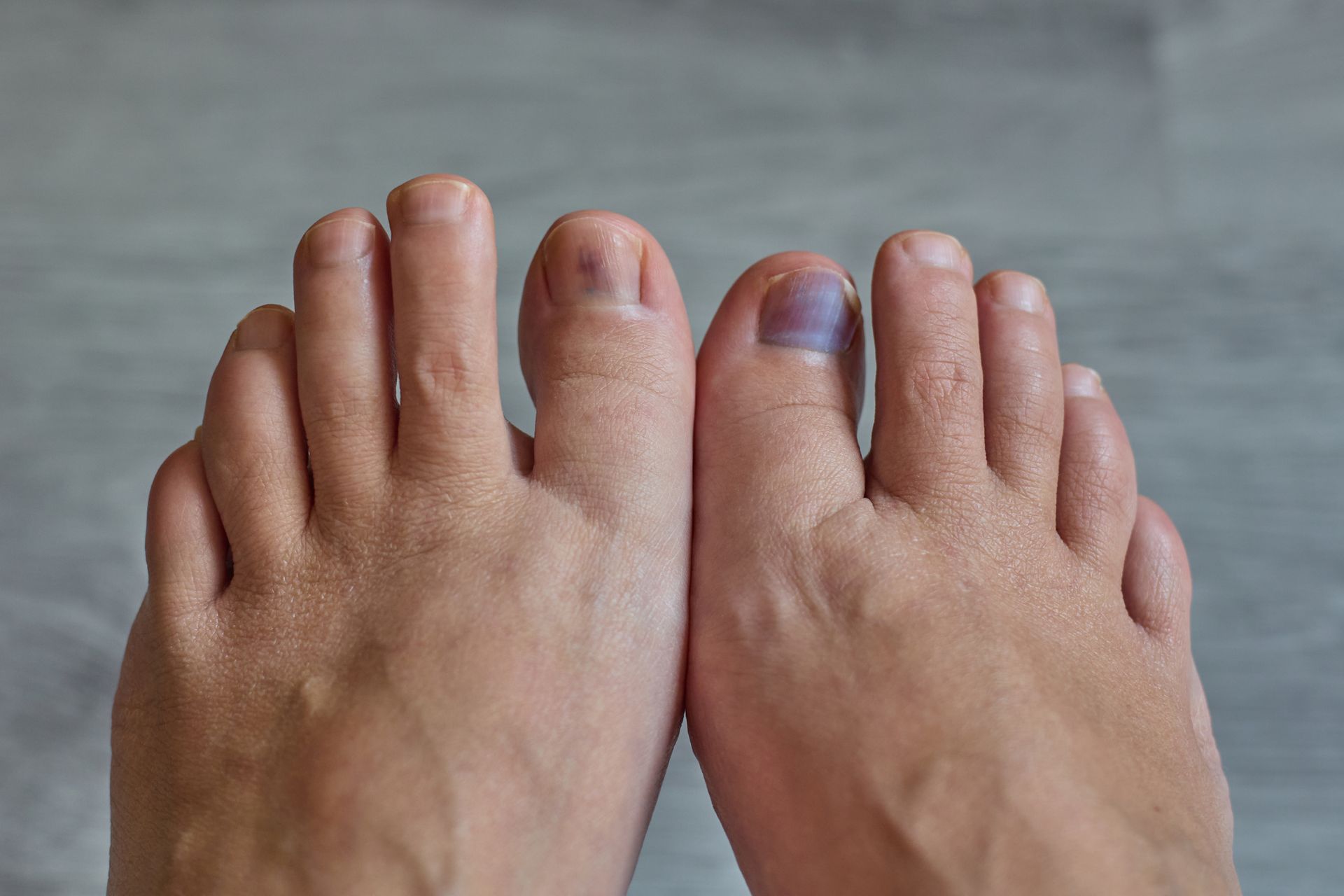 Nail Discoloration Treatment