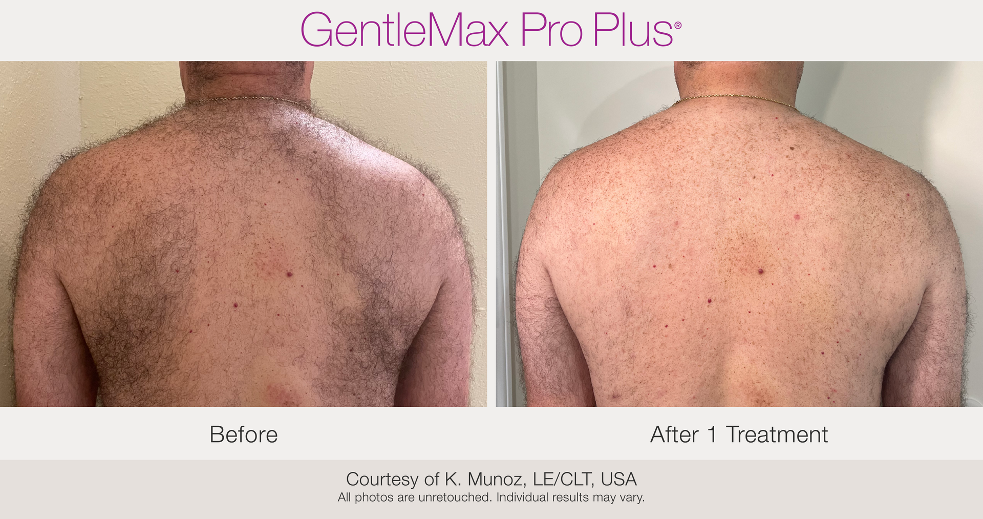 Before and After Laser Hair Removal