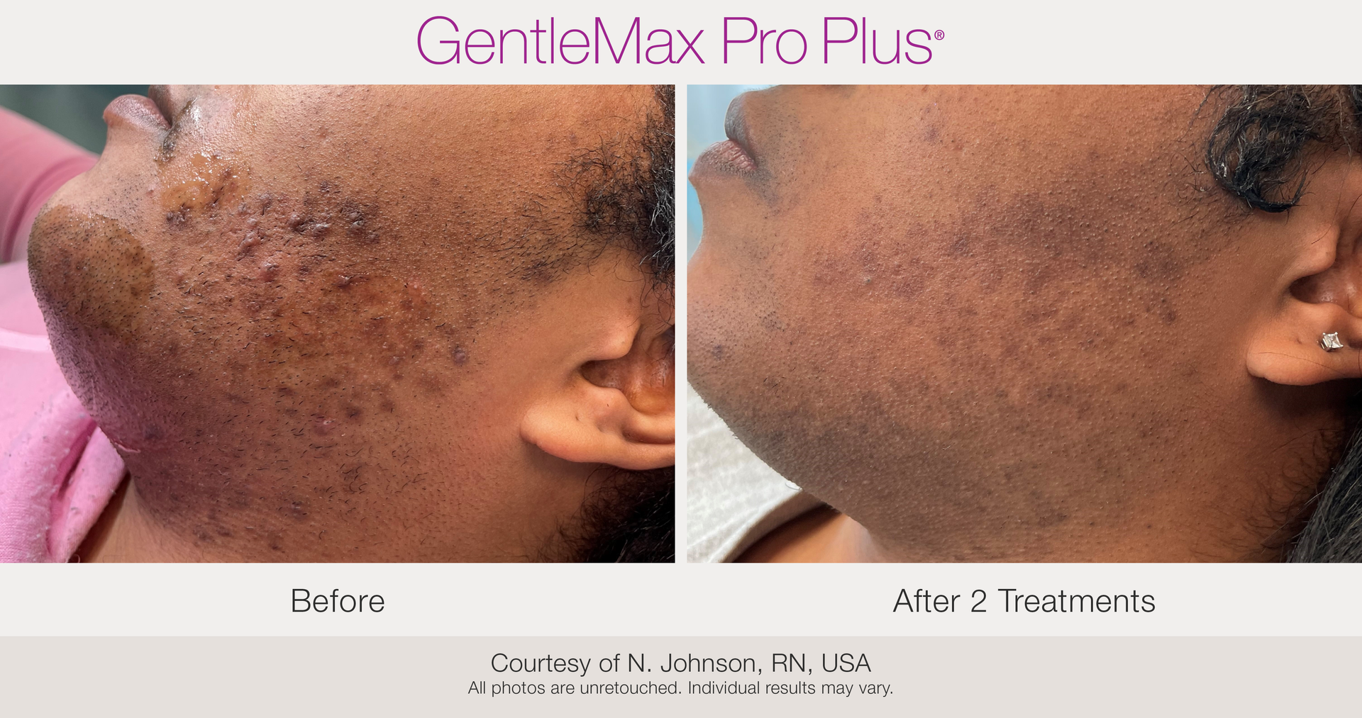 Before and After Laser Hair Removal