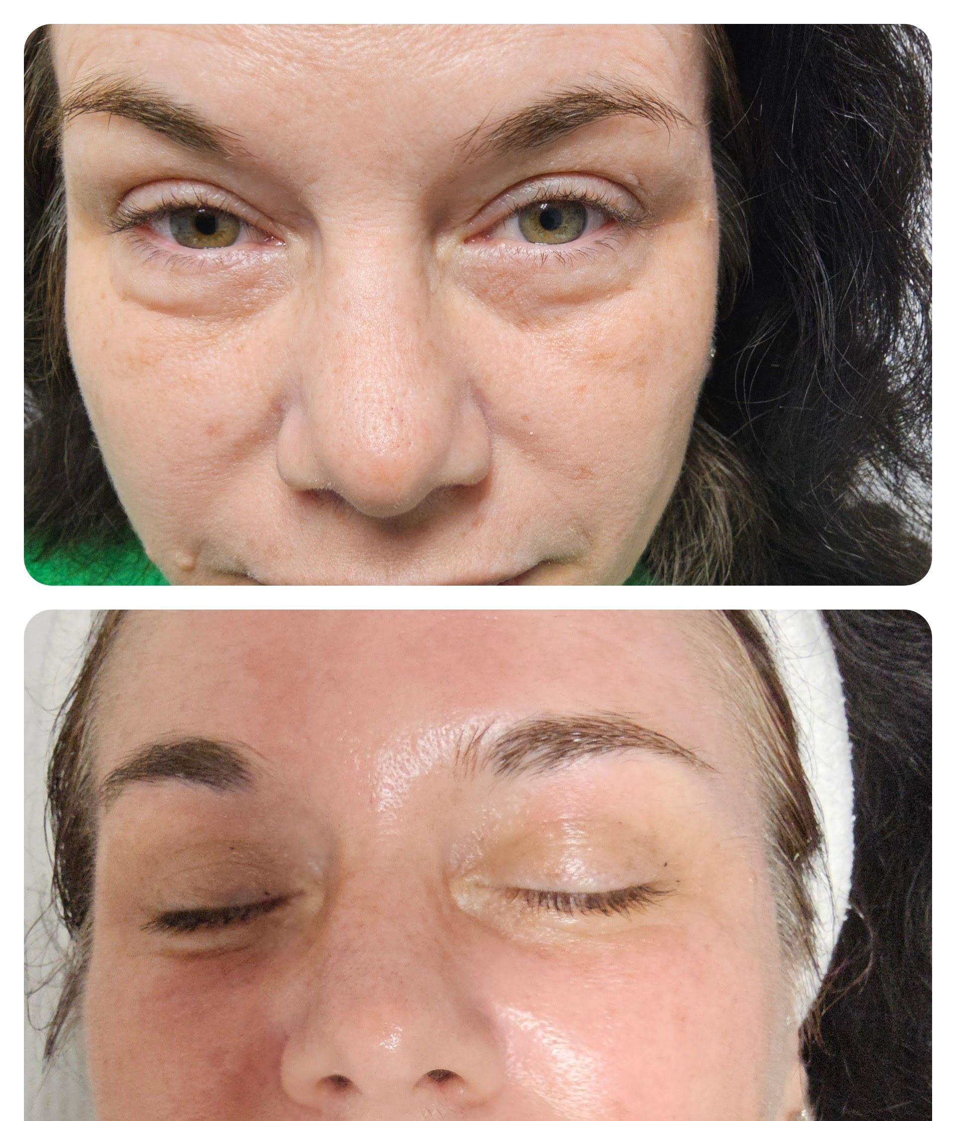 before and after PRX Derm Perfexion
