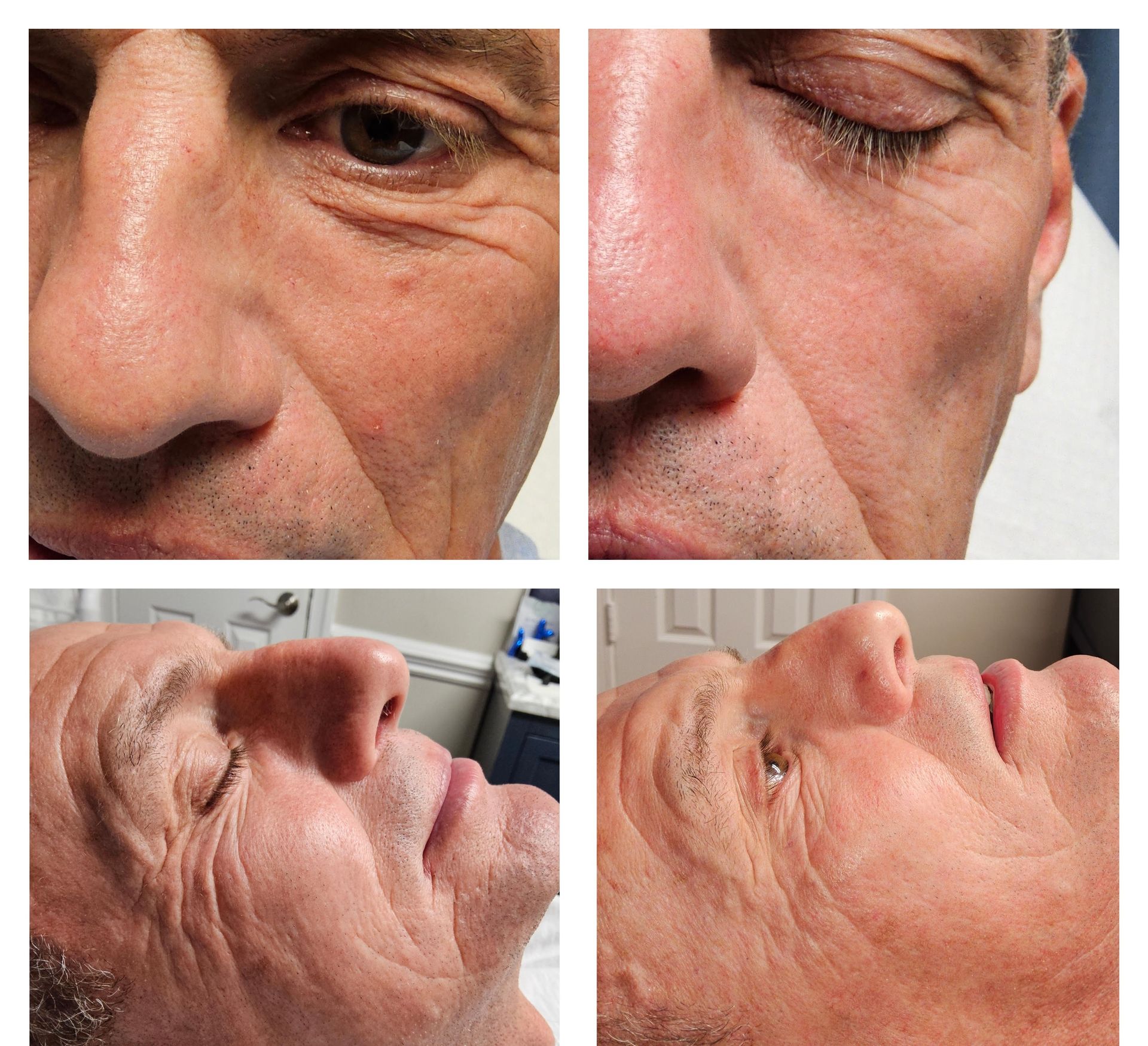 before and after PRX Derm Perfexion