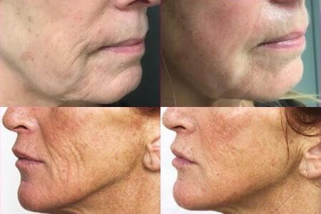 before and after PRX Derm Perfexion