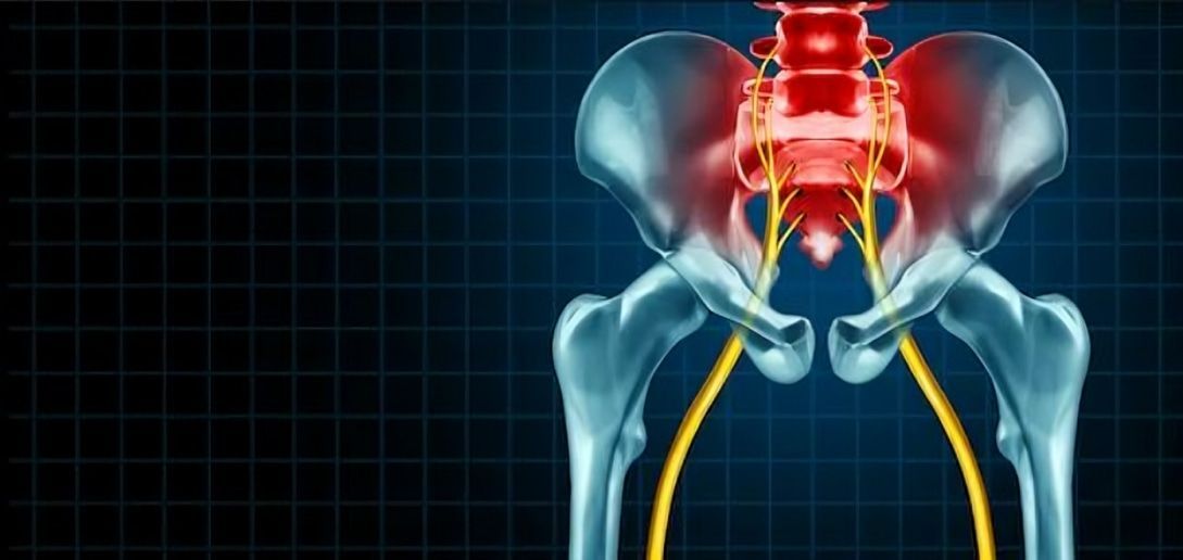 A Person 's Pelvis With a Skeleton and Nerves — Anderson Family Chiropractic Health Centre in Mount Pleasant, QLD