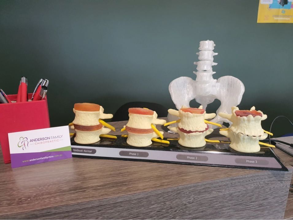 A Model of the Spine and Pelvis is on a Table — Anderson Family Chiropractic Health Centre in Mount Pleasant, QLD