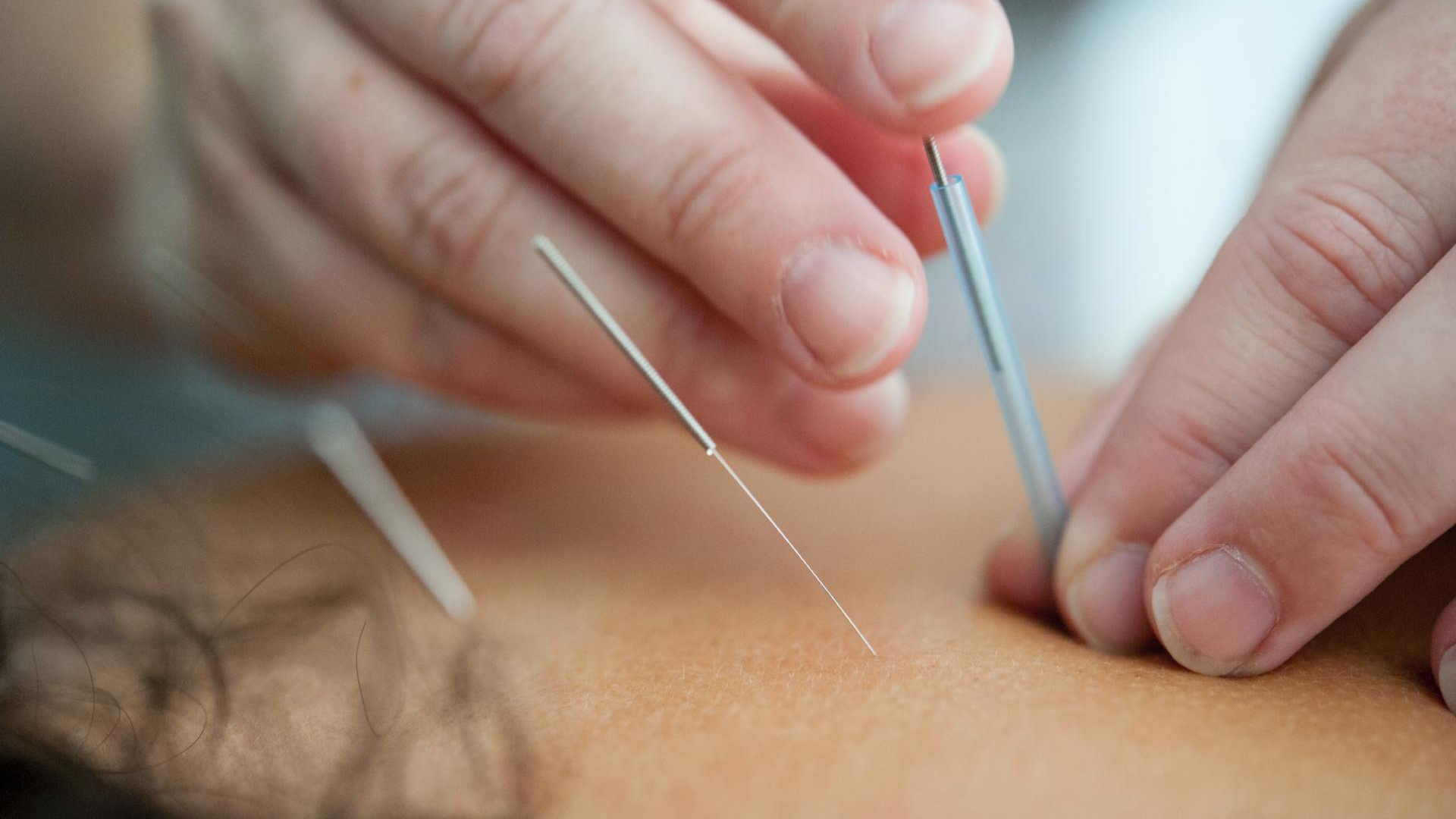 accupuncture richmond hill on