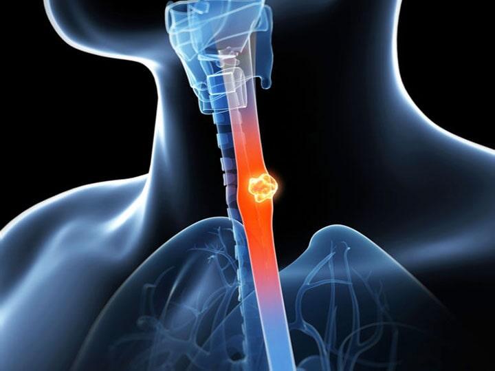 DR. JAVIER VALDEZ FERNÁNDEZ - PROBLEMAS EN EL ESÓFAGO