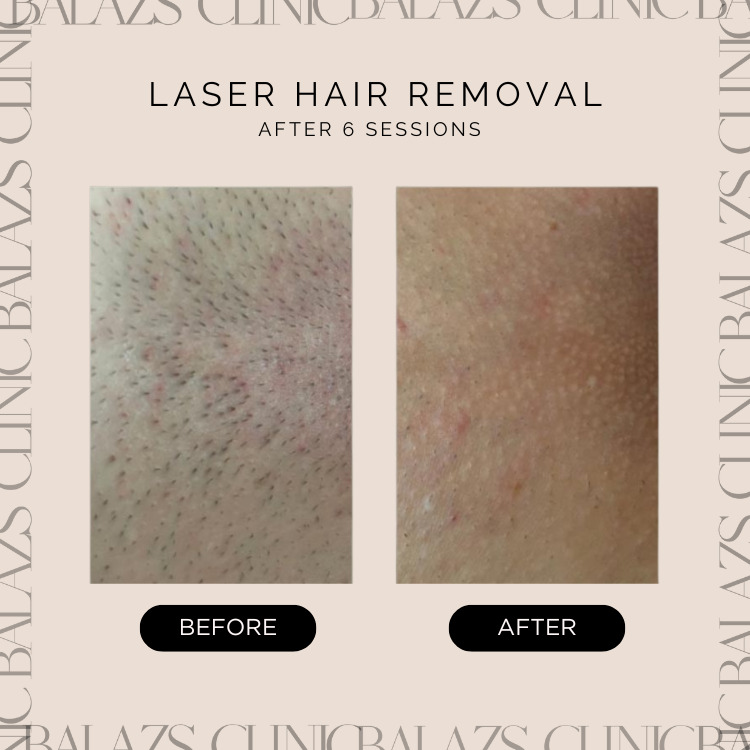 laser hair removal warrington