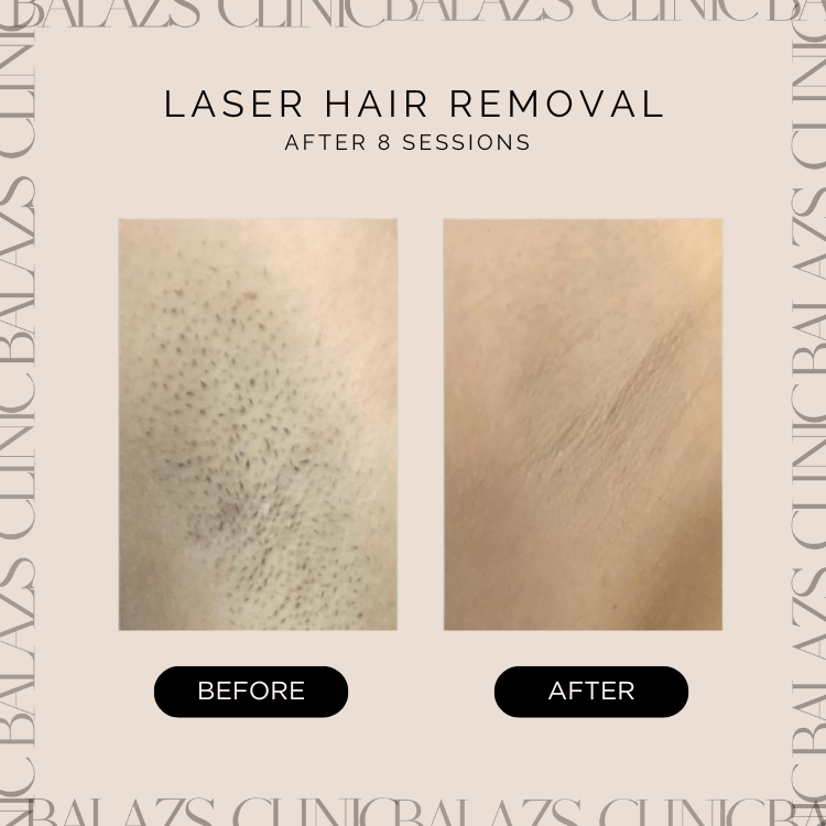 laser hair removal warrington