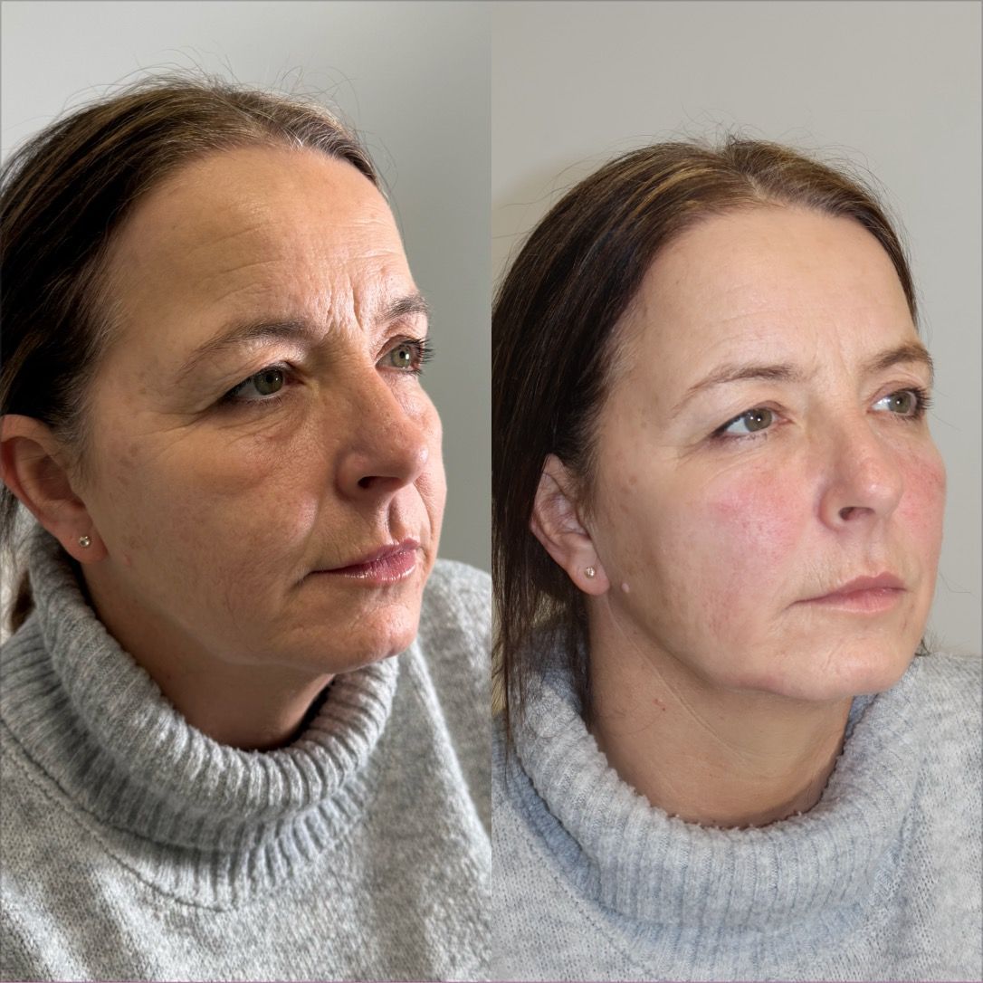 profile balancing dermal fillers in warrington