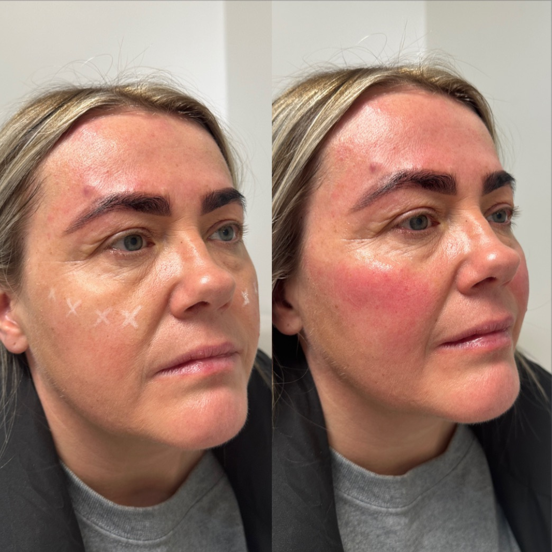 profile balancing dermal fillers in warrington