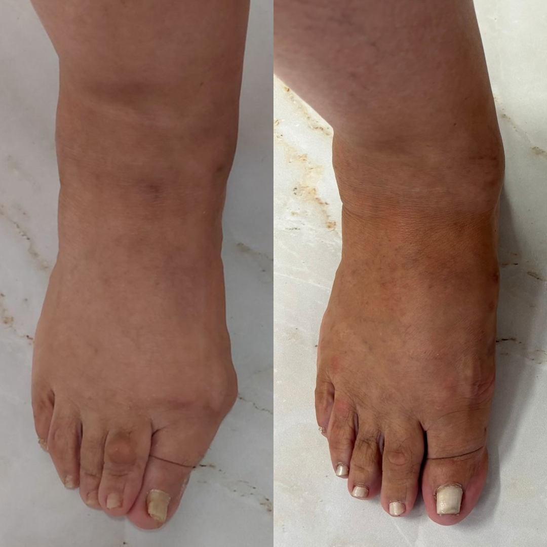 Joanete antes e depois