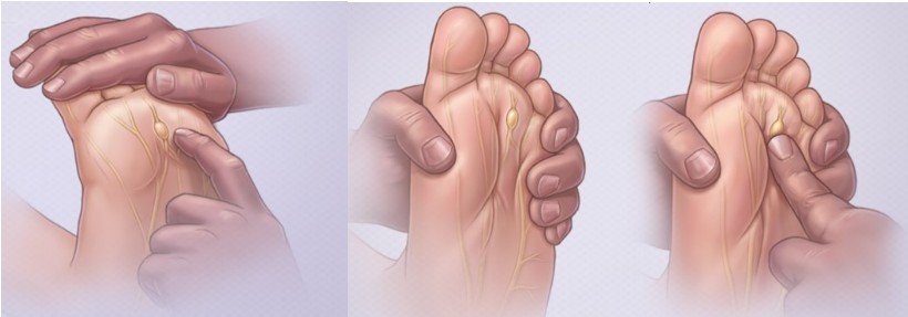 Neuroma de morton